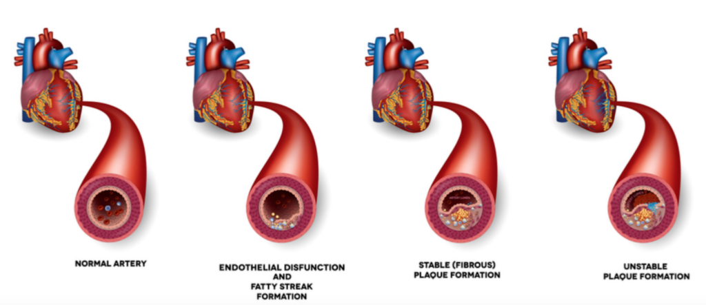 Язва сердца. Атеросклероз венечных артерий сердца. Ишемическая болезнь сердца атеросклероз коронарных артерий. Атеросклероз стенокардия. Атеросклероз ИБС стенокардия.